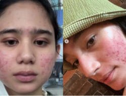 5 Seleb yang Berjuang Melawan Jerawat Membandel, Ada Tissa Biani dan Tatjana Saphira